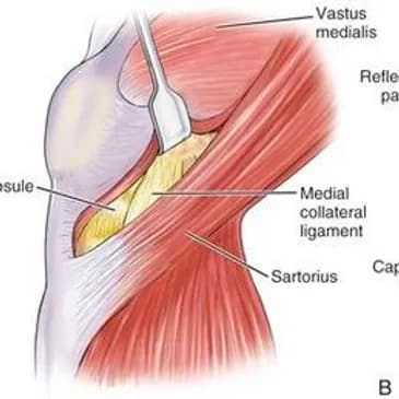 Medical illustration of a knee seen from the side during a Jiffy Knee procedure. A retractor lifts the vastus medialis muscle aside to expose the joint capsule, leaving the muscle and tendon uncut.